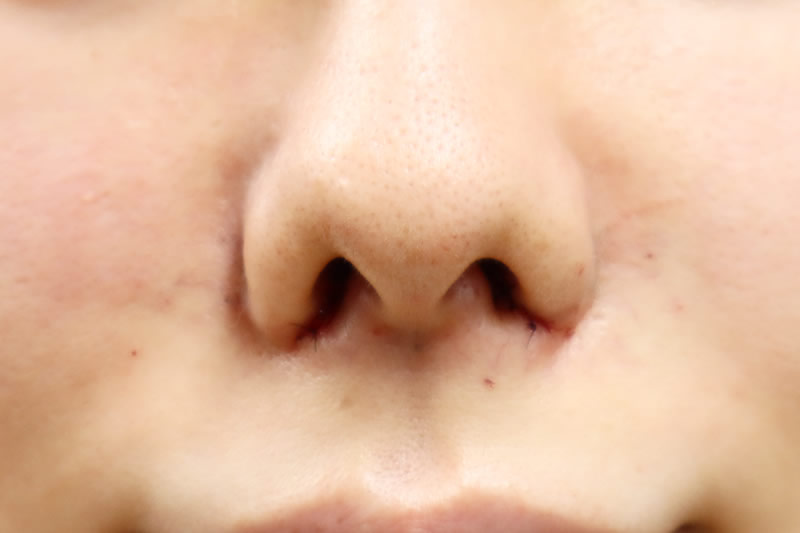 内側切開による小鼻縮小の直後の腫れや内出血の状態（正面）