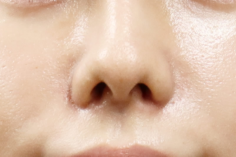 内側切開による小鼻縮小の１週間後の腫れや内出血の状態（正面）
