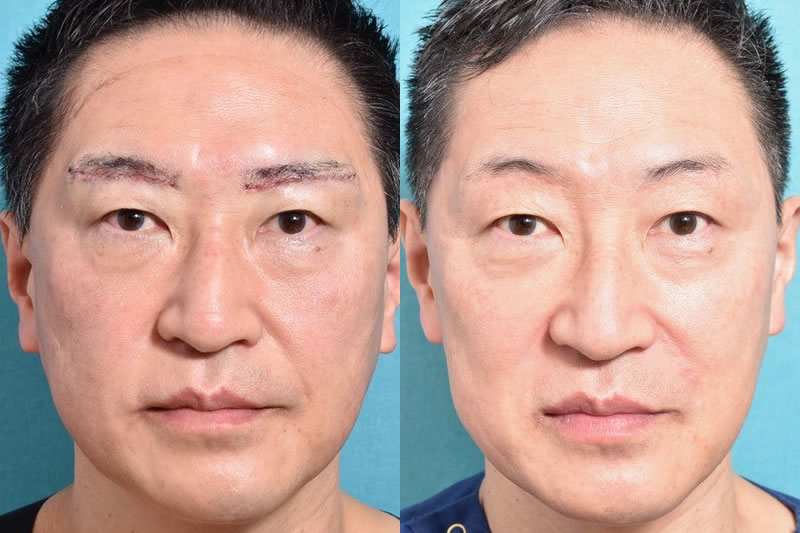 眉下切開の手術後の傷跡の症例