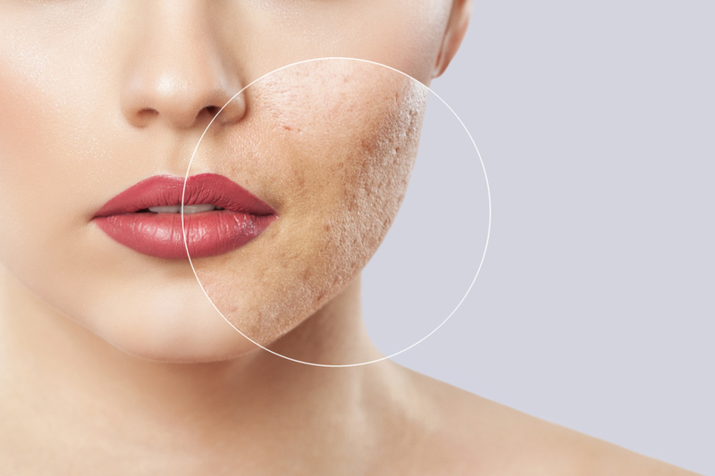 クレーター肌の原因やセルフケア方法を美容外科医が解説