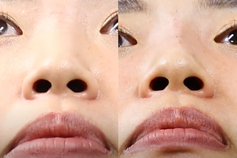 鼻のヒアルロン酸のダウンタイムの症例