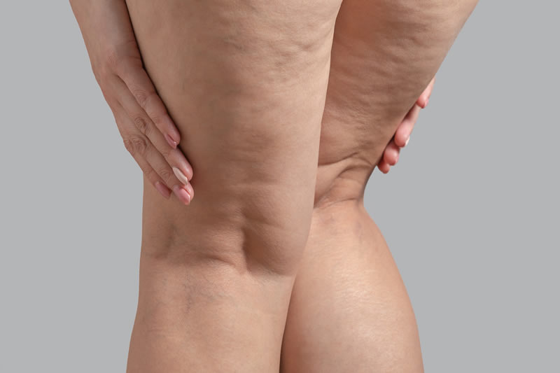 太もものセルライトを解消するためにはどうすればいい？原因と解消方法をご紹介