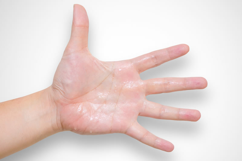 手汗が止まらない。手汗が多くなる原因や治療法について解説