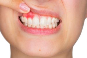 歯周病を気にしている女性
