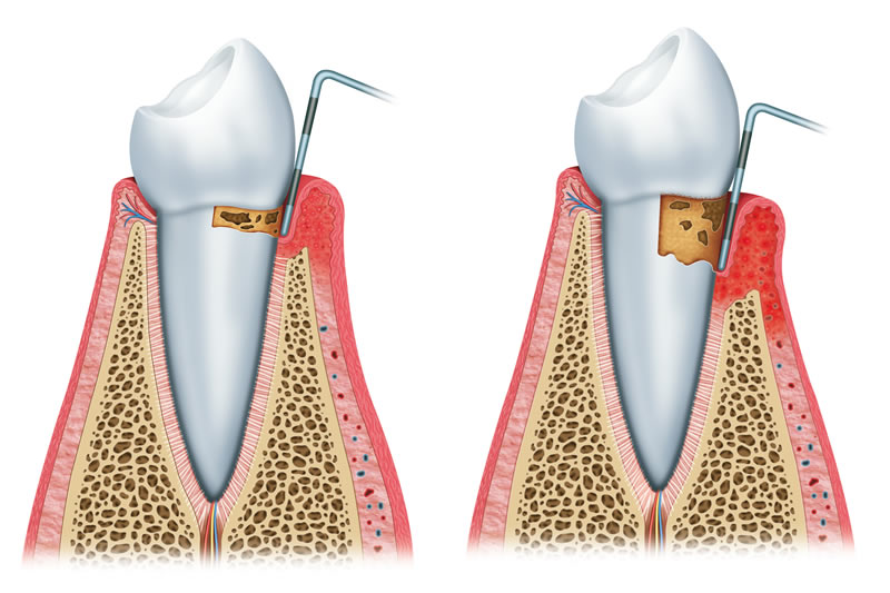 歯周病治療
