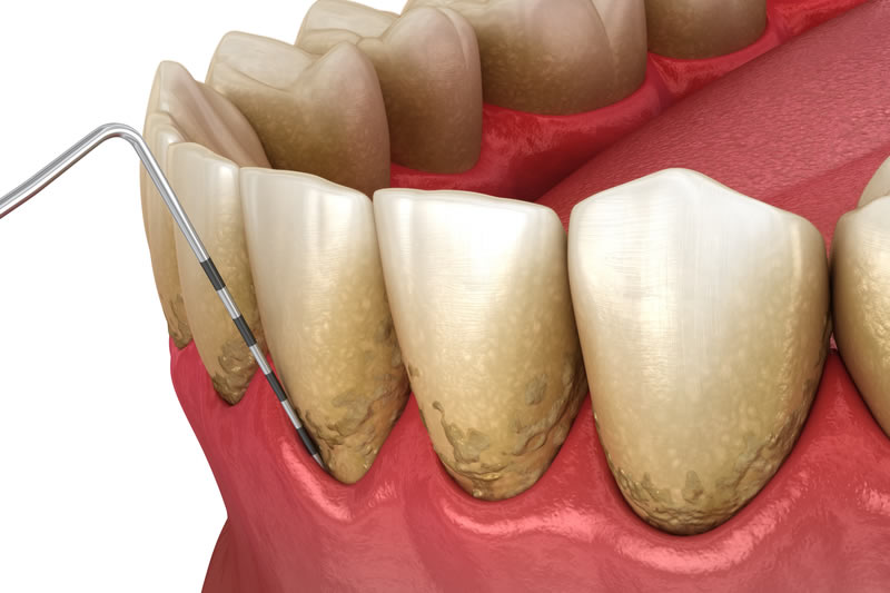 歯周病になったらどんな症状が出る？セルフチェック項目や悪化を防ぐ方法について解説