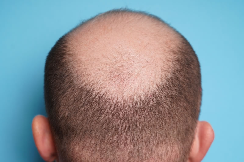 自毛植毛の費用は高い 施術メニューと相場を解説 共立美容外科