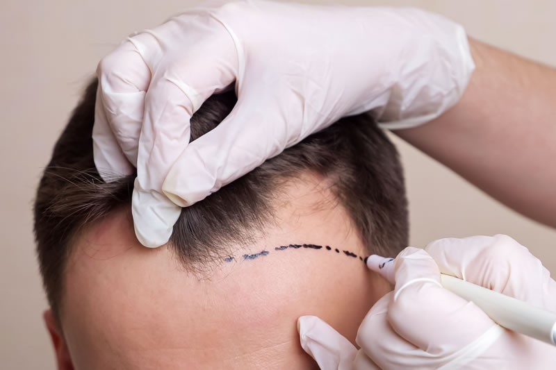 自毛植毛の費用は高い 施術メニューと相場を解説 共立美容外科