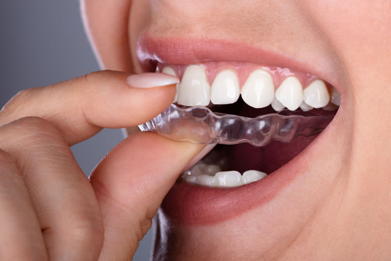 歯並びが悪いとどんな影響がある？歯列矯正のメリットと種類