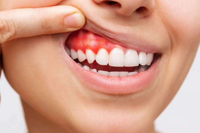 歯茎の再生治療について医師が分かりやすく解説