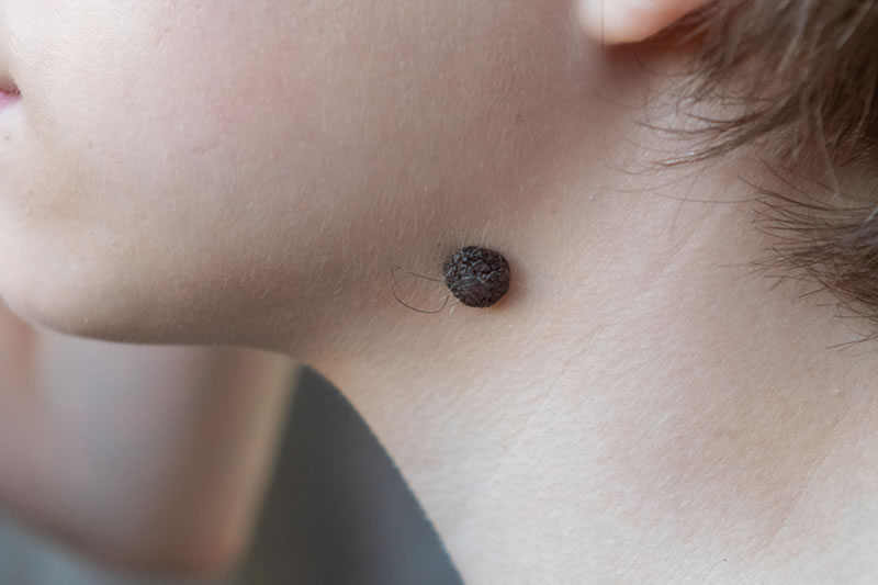 生まれつきの大きいほくろ 原因は どうやって除去する 共立美容外科 生まれつきの大きいほくろ 原因は どうやって除去する 共立美容外科