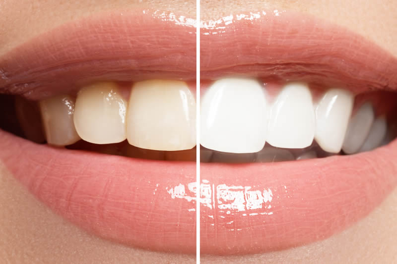 歯が黄色い9つの原因を徹底解説！黄ばみの予防方法や歯を白くする方法もご紹介