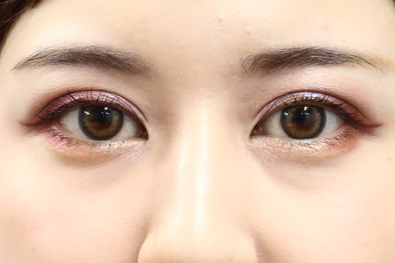 二重まぶたの女性