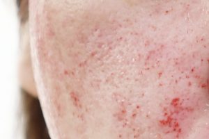 ダーマペンの直後の赤み