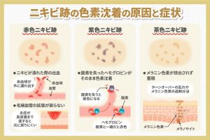 ニキビ跡の色素沈着の原因と症状