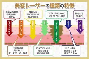 美容レーザーの種類の特徴