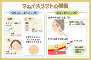 フェイスリフトの種類