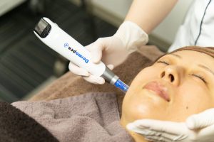 ダーマペン４の施術を受けている様子