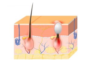 白ニキビのイメージ図