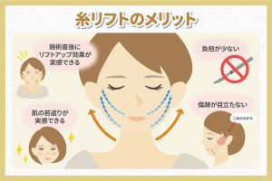 糸リフトのメリット