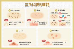 ニキビ跡5種類