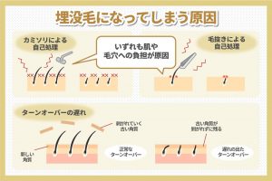 埋没毛になってしまう原因