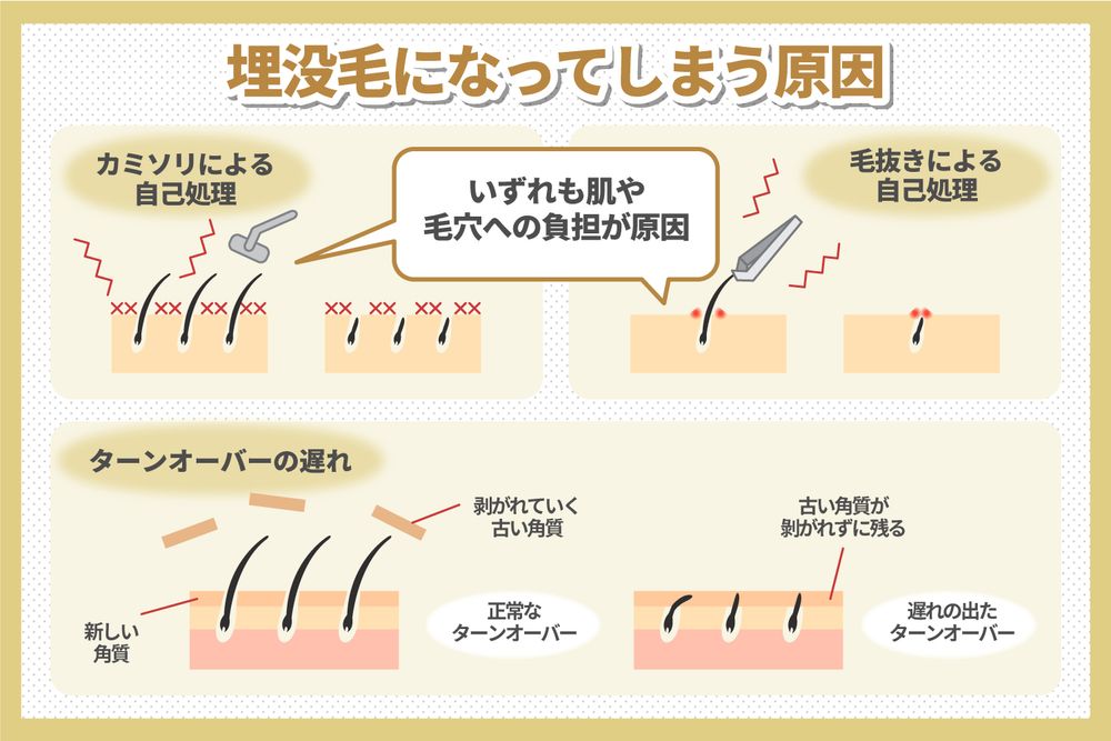 埋没毛とは?原因と防止方法、適切な処置を解説