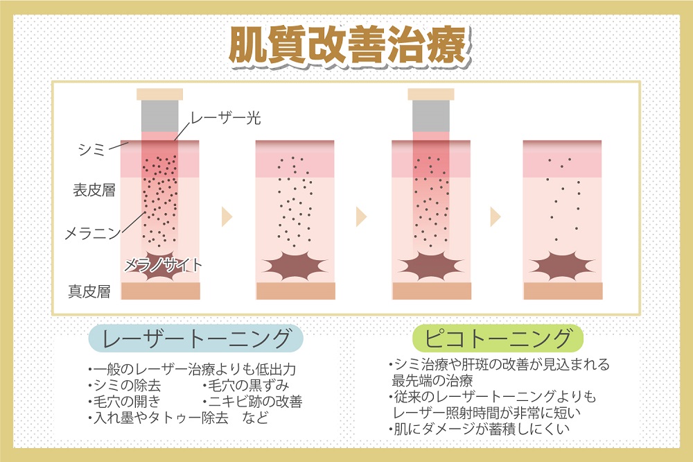ピコトーニングとレーザートーニングの違い、効果について美容外科医が解説