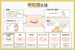 稗粒腫についての説明