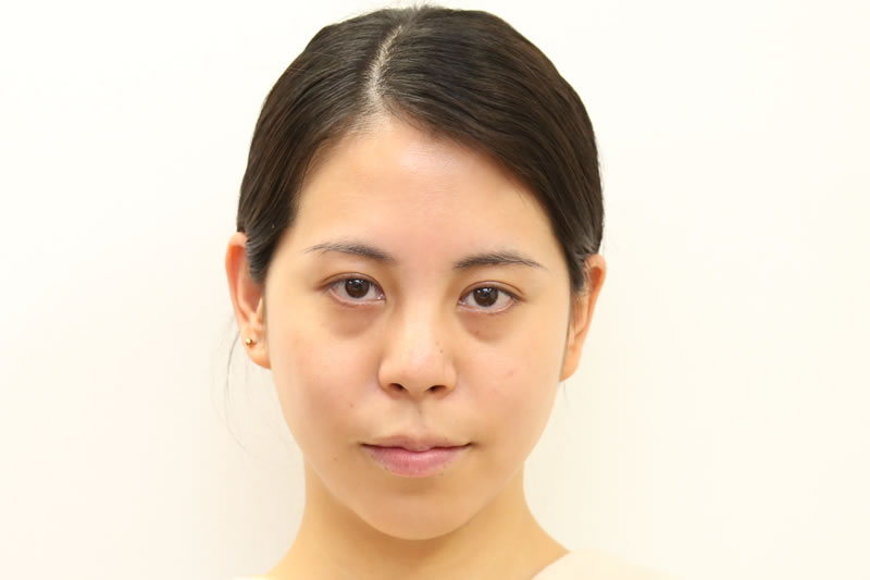 目の下にふくらみがある女性