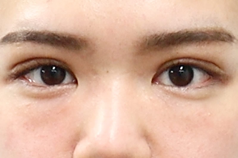 1か月後の目を開いている状態