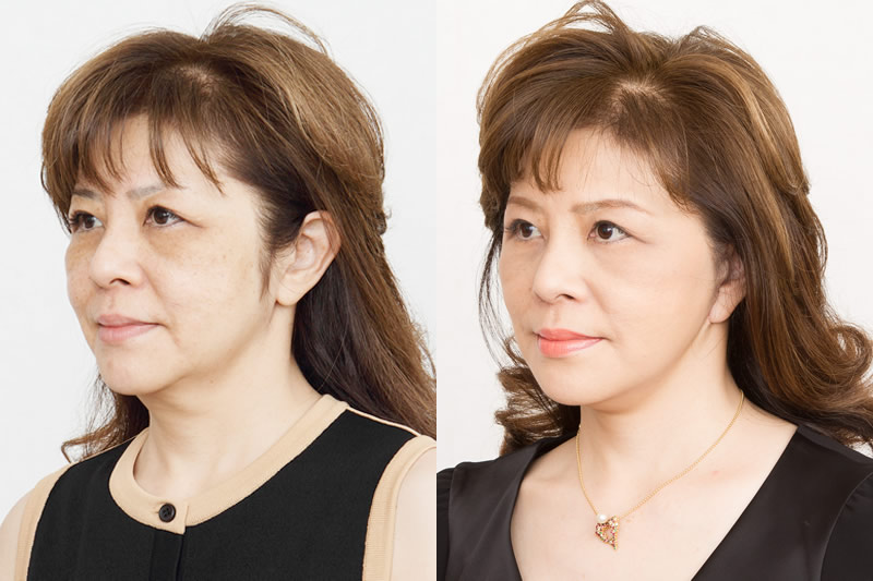 50代女性のフェイスリフトの症例写真の斜め