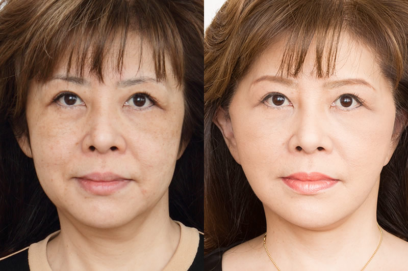 50代女性のフェイスリフトの症例写真の正面