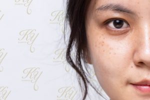 シミがある30代の女性