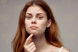 ニキビを気にする20代の女性