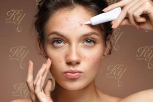 ニキビを自分で治そうとする女性