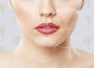 ニキビ跡のイメージ