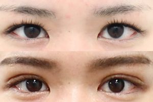 二重切開の修正手術の症例写真