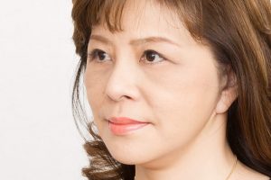 切開フェイスリフトの手術後１カ月後の左斜め