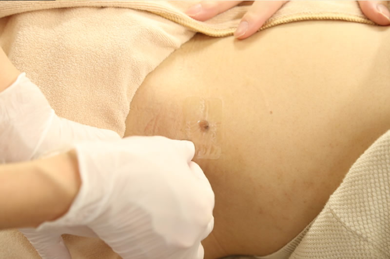 女性のお腹のほくろ