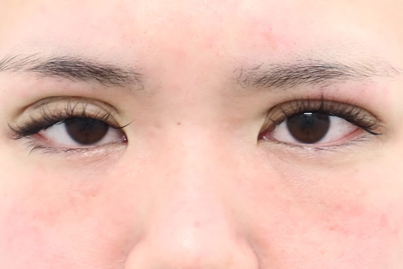 手術直後の目を開いている状態