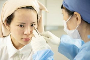 目の下の脂肪注入がおわったところ