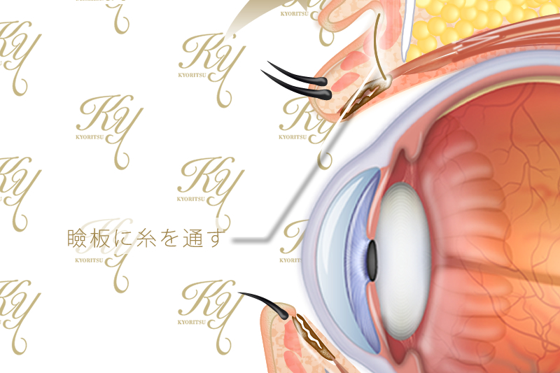 まぶたと眼球の断面のイラスト。「瞼板に糸を通す」と書かれている