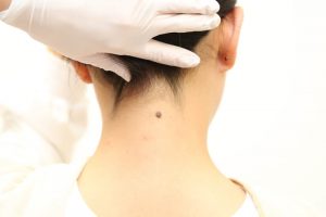 首のほくろを気にする女性