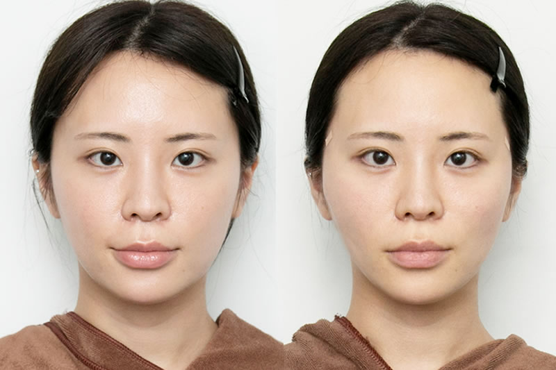 20代後半の方の糸リフトの手術直後の症例