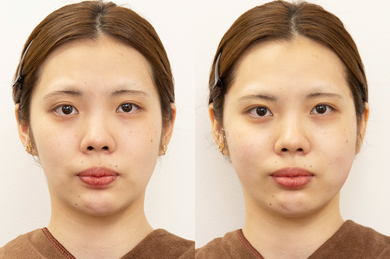 20代方の糸リフトの手術直後の症例