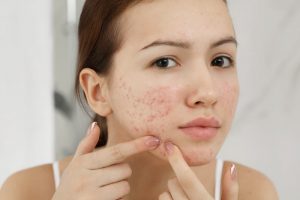 ニキビが気になる女性