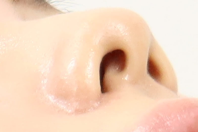 内側切開による小鼻縮小の１週間後の腫れや内出血の状態（横）