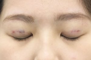 埋没法の直後の内出血