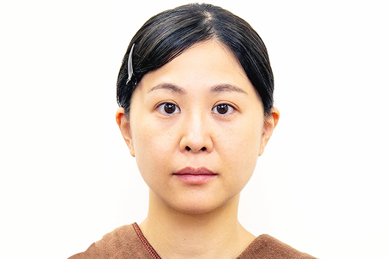 糸リフトの3週間後の症例